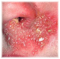 cold sores in nose
